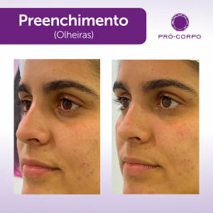 Preenchimento Olheira Fotos  Antes e Depois